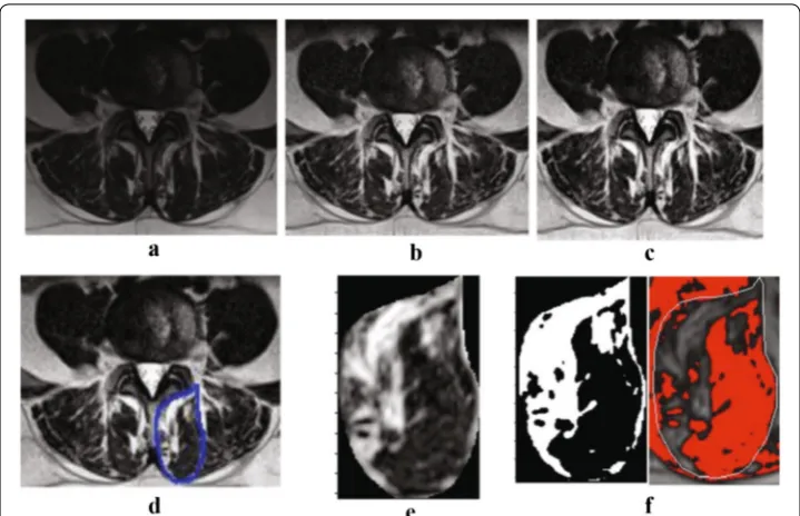 Fig. 1 A sample MRI image at L4–L5 and the processed image after each step of the algorithm; MRI image, areaing technique (a the original b adaptive equalized algorithm image, c adjusted contrast image, d the select area, e the cropped  of the selected ROI, f the resulted binary image from automated algorithm (left) and manual threshold-right)