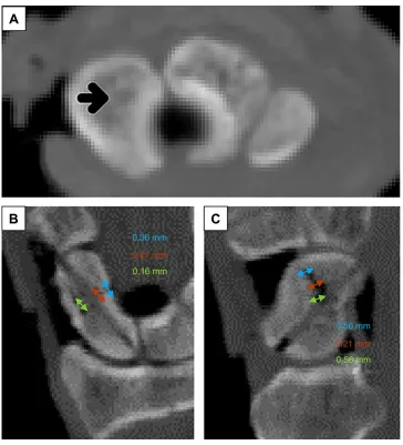 Figure 3 CT imaging of a scaphoid fixed with ASS with fracture gap measurement.Notes: (A) horizontal plane