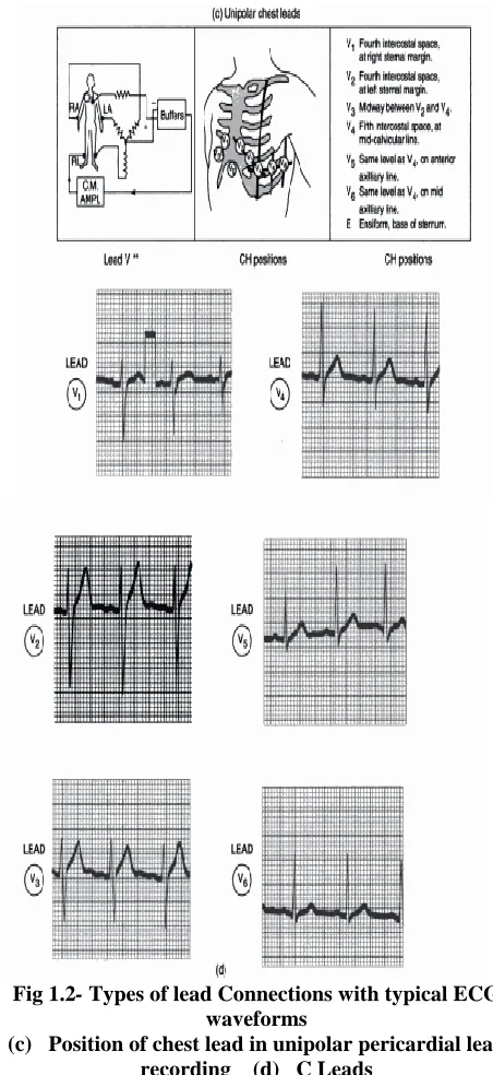 Fig 1.2- Types of lead Connections with typical ECG  waveforms 