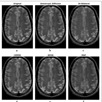 Fig. 8 Filtering results for one slice of the 1.5 T real axial dataset: acquired noisy image (a), filtering result achieved by anisotropic diffusion (b), 3D bilateral (c), LMMSE (d), BM3D (e) and proposed MAP (f) filters