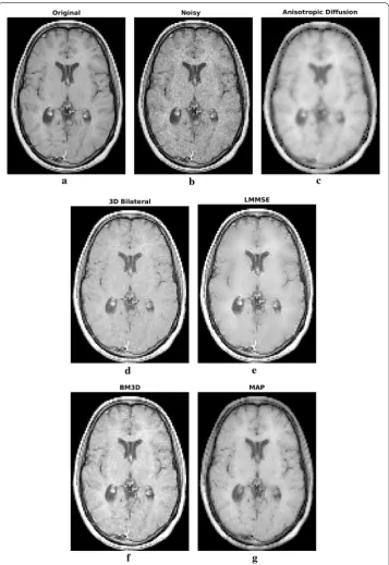 Fig. 3 Filtering results for one slice of the phantom dataset: original (achieved by anisotropic diffusion (a) and noisy (b) image, filtering result c), 3D bilateral (d), LMMSE (e), BM3D (f) and proposed MAP (g) filters