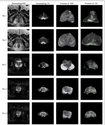 Fig. 7 The resampling images and prostate images for the five samples. The 1st and 2nd columns display the resampling MR slices and TRUS slices, respectively