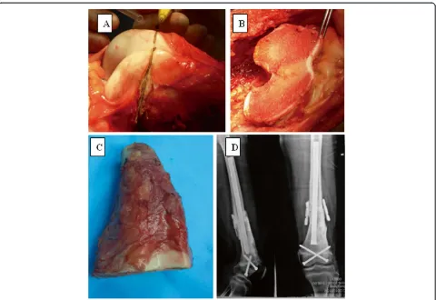 Figure 2 Results for a patient treated for osteosarcoma. (A) The epiphysis of the distal femur was preserved by marginal resection; (B) theremaining epiphysis; and (C) the resected tumor