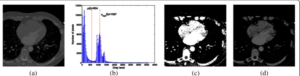 Figure 2 Example of thresholdi006Eg with μsup(k). (a) Original slice, (b) histogram, (c) binary mask computed by thresholding with μsup(k),and (d) masked slice.