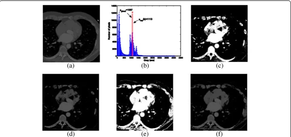 Figure 4 Example of thresholding with μglobal. (a) Original slice, (b) histogram, (c) binary mask computed by thresholding with μsup(k), (d)original slice masked with (c), (e) binary mask computed by thresholding with μglobal, and (f) original slice masked with (e).