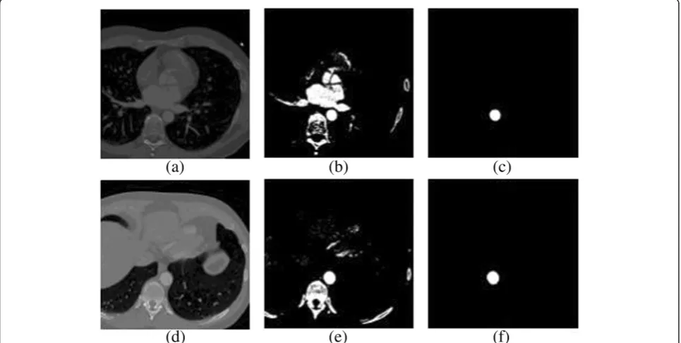 Figure 8 Location of the aorta. (a)pixels belonging to the aorta, Original slice, (b) binary mask computed by thresholding with μsup(k) + σ(k), (c) object which contains the (d) original slice with too much liver, (e) binary mask computed by thresholding with μsup(k) + σ(k), and (f) objectwhich contains the pixels belonging to the aorta.