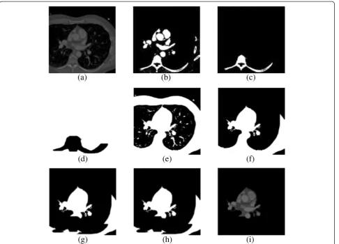 Figure 9 Deletion of the spine. (a) Original slice, (b) binary mask computed by thresholding with μsup(k), (c) object which contains the pixelsbelonging to the spine, (d) binary mask computed as the negative of the morphological dilation, (e) binary mask computed by thresholding withμ(k), (f) ROI before the deletion of the spine, (g) application of mask (d) to the ROI, (h) restoration of the aorta, and (i) masked slice.