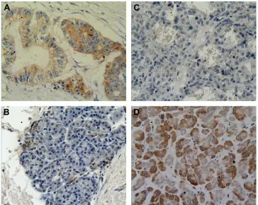 Figure 1 immunohistochemical staining for secreted MiCa and nKg2D.Notes: The secreted MiCa and nKg2D were principally localized in the cytoplasm of the cells