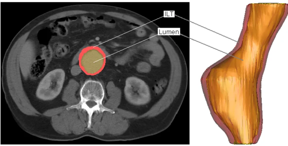 Figure 1Typical CT scan and 3D reconstruction of patient suffering from an AAATypical CT scan and 3D reconstruction of patient suffering from an AAA