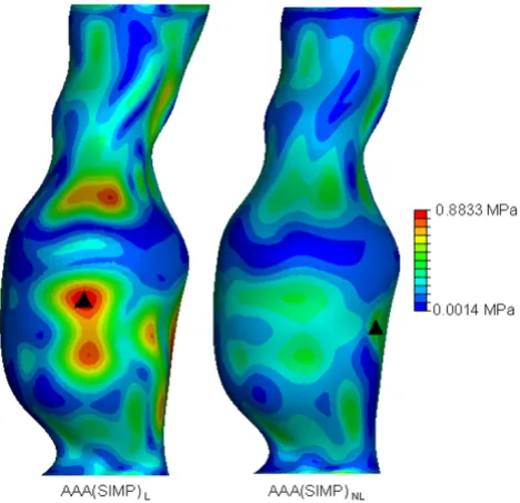 Figure 5AAAindicates the region of peak wall stress. Models are shown in mmHgand von Mises wall stress distributions for both the AAA(SIMP)(SIMP)NL models at an internal pressure of 120 L von Mises wall stress distributions for both the AAA(SIMP)L and AAA(