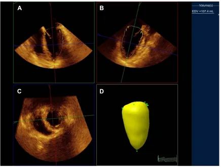 Figure 1 Measurement of left ventricular (lV) end-diastolic volume (eDV).Notes: After setting five points (S: septal, L: lateral, A: anterior, I: inferior, and apex), the system automatically tracks the complete LV endocardial borders to calculate the lV v