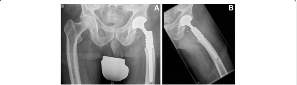 Figure 2 (A) and (B) Radiographs showing a representative case of a proximal femur metastasis: (A) anterior-posterior and (B) axialradiograph of the proximal femur of a 76-year-old male patient with a renal cell carcinoma metastasis