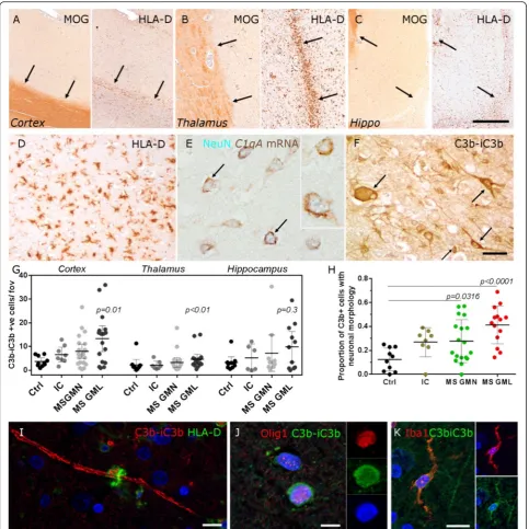 Fig. 1 Complement activation in MS grey matter lesions. Complement expression was investigated in cortical (a) and subcortical (b, c) greymatter characterised by anti-myelin oligodendrocyte glycoprotein (MOG) and anti-HLA-D immunochemistry, to reveal demye