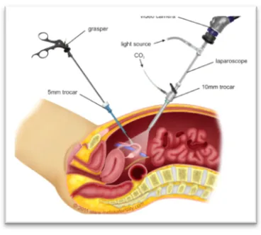 Figure 1 Laparoscopic Surgery 