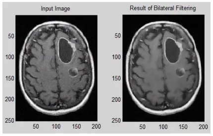 Figure-2. Result of bilateral filter. 