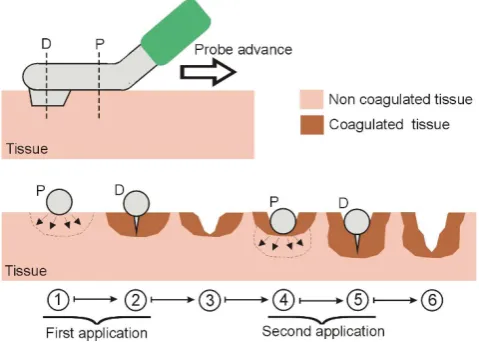 Figure 3Secondary function of the new RF-assisted device forrapid bloodless resection