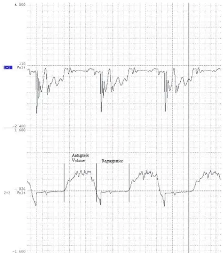 Figure 7dition utilizing a second-generation prototypic valveRepresentative differential pressure (top) and flow rate (bottom) waveforms from the physiologic system under the STBR con-Representative differential pressure (top) and flow rate (bottom) wavefo