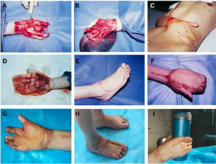 Figure 3 Female patient, 34 years old, with degloving damage involving all of the digits except the thumb.Notes: (A) Palm after debridement; (B) hand back after debridement; (C) embedding of the abdominal skin flap; (D) lateral side of the palm after the abdominal flap was removed; (E) design of the dorsalis pedis skin-flap removal; (F) preliminary healing of the foot flaps; (G) appearance during the final follow-up; (H) function during the final follow-up; (I) healing of the donor area.