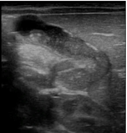 Figure 2 Mass-like sludge in common bile duct (A) and the gallbladder (B).