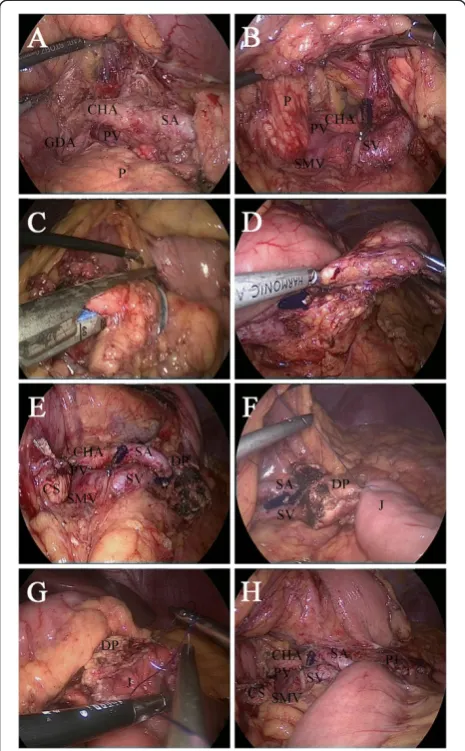 Figure 5 Resected specimen of the mixed mucinouscystadenoma with serous cystadenoma of the pancreas.