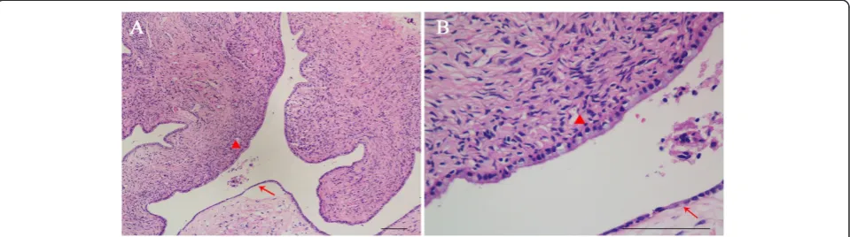 Figure 6 Histological features of the mixed mucinous cystadenoma with serous cystadenoma of the pancreas.the mucous columnar epithelium and the arrow indicates the cuboidal epithelium