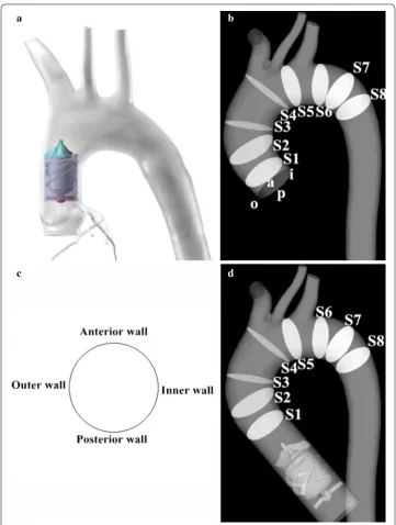 Fig. 1 for flow pattern presentation. a The scheme of implantation position of series type LVAD
