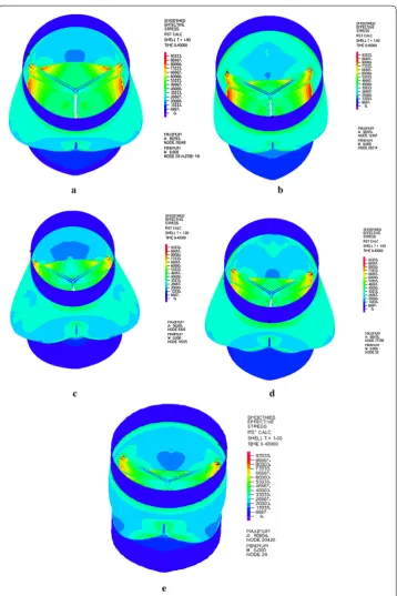 Fig. 3 Stress of neo-aortic root during diastole for all models. The neo-aortic root models from SD the maximum stresses of 96.29, 98.34, 96.28, 98.26 and 90.60 kPa, respectively