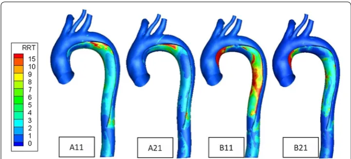 Fig. 7 Relative residence time (RRT) contours plots of the four models. High RRT predicts larger possibil-ity of false lumen thrombosis
