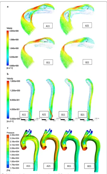 Fig. 3 Velocity and wall pressure analysis at systolic peak. ascending aorta with aorta arch section (display true and false lumen intuitively