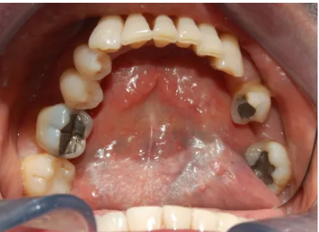 Figure 3 Dry and sticky appearance of oral mucosa in a radiotherapeutic patient.