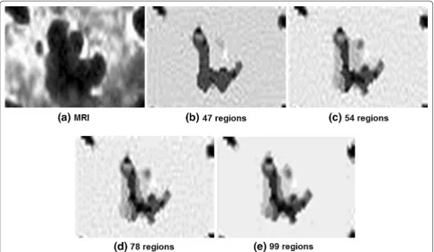 Fig. 4 Using the MRI scanned tissue (a), the HCS process outputs (b–e) are displayed with indication of the number of regions detailed