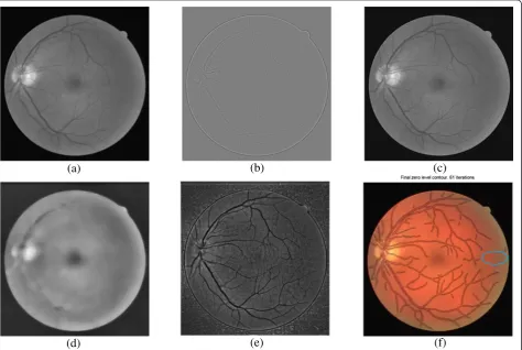 Figure 11 Preprocessing step and segmentation of non-pathological retinal fundus image obtained from DRIVE dataset