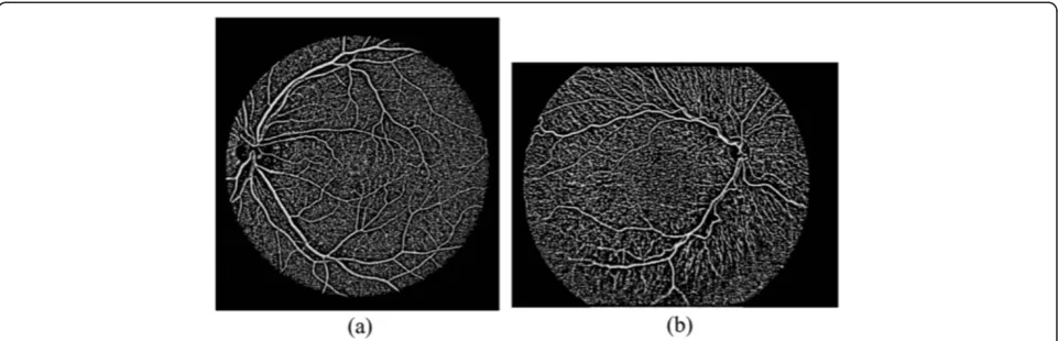 Figure 8 Features of the green channel components for retinal fundus images in Figure 1.shown in Image edges are shown in (a) and (d), lines are (b) and (e), and structures from our modified phase map approach are shown in (c) and (f)