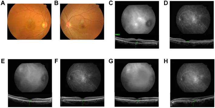 Figure 1 The changes of subfoveal choroidal thickness after photodynamic therapy.