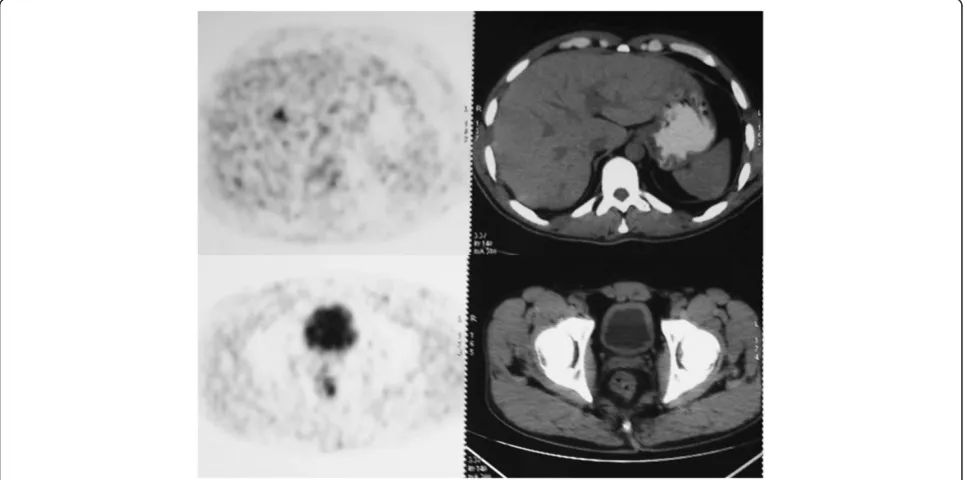 Table 5 Additional distant lesions detected by PET/CT