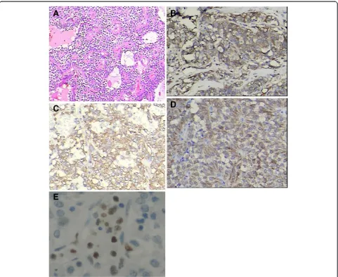 Figure 3 Histopathology of SPTs. (A) Sheets and cords of cells arranged around fibrovascular septa and pseudopapillary structures are formed.(H&E × 100)