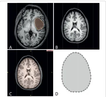 Figure 1 Segmented MRI of the head used to construct a patient specific brain mesh. (a) Tumorsegmented in a pre-operative image
