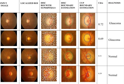 Table 1.  Simulation results of  input images for glaucoma screening 