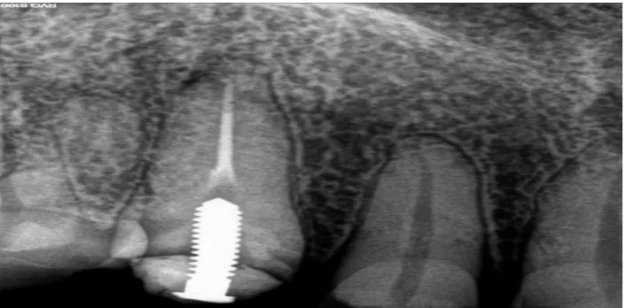 Figure 11  radiograph showing poor prognosis with post and core 