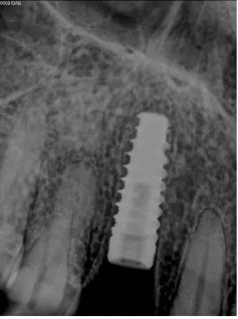 Figure 13  abutment in place 
