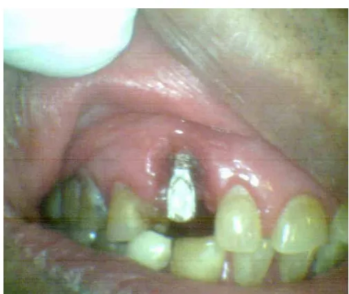 Figure 15  PUTTY IMPRESSION- ONE STAGED TECHNIQUE 