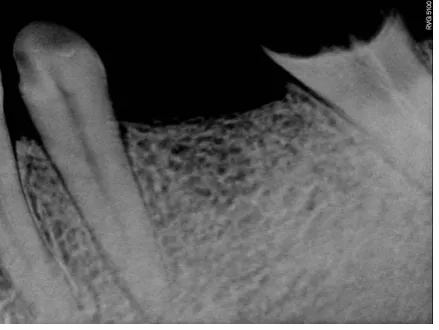 Figure 16 post prosthesis fixation 