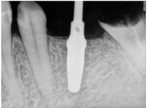 Figure 19  IMLANT IN PLACE  