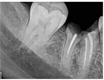 Figure 2  implant post extraction 