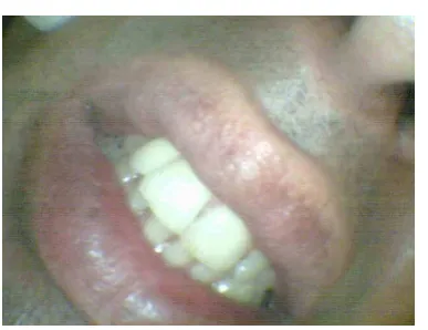 Figure 9  implant prosthesis loaded 