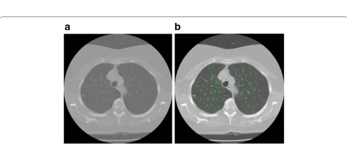 Fig. 8 Segmentation results of pulmonary parenchyma. tion, a Original image, b optimal threshold segmenta-c mending image of pulmonary parenchyma based on morphology method; d segmentation result of pulmonary parenchyma