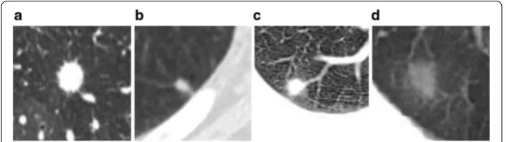 Fig. 1 Some classical pulmonary nodules. a Well-circumscribed nodule; b Juxta-pleural nodule; c Juxta-vascular nodule; d GGO nodule