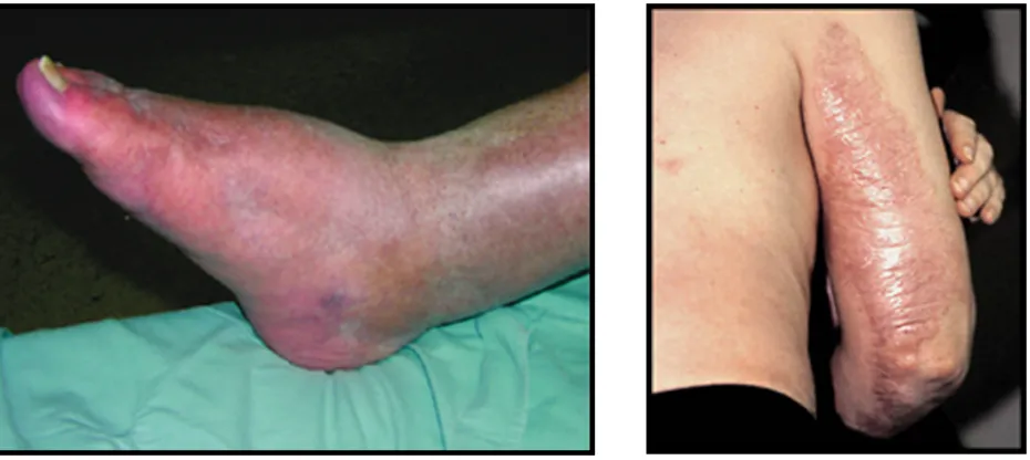 Figure 1.6. Visible symptoms or signs of NSF/NSD [16-17].  