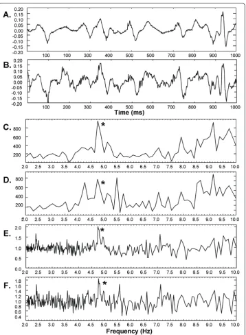 Figure 7 A. CFAE from a paroxysmal AF patient - anterior left atrial free wall. B. The CFAE withrandom noise added