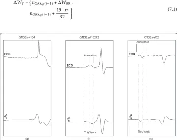 Figure 7 Delineation of P waveand delineated characteristic points (bottom): P onset, dominant P peak, P offset